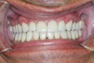 Real Patient Cases Before and After from McLean Aura Dentistry in McLean, VA from Dr. Negar Tehrani, DMD your top dentist in McLean