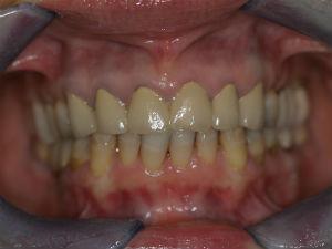 Real Patient Cases Before and After from McLean Aura Dentistry in McLean, VA from Dr. Negar Tehrani, DMD your top dentist in McLean