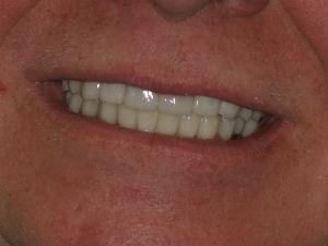 Real Patient Cases Before and After from McLean Aura Dentistry in McLean, VA from Dr. Negar Tehrani, DMD your top dentist in McLean