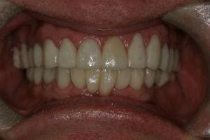 Real Patient Cases Before and After from McLean Aura Dentistry in McLean, VA from Dr. Negar Tehrani, DMD your top dentist in McLean